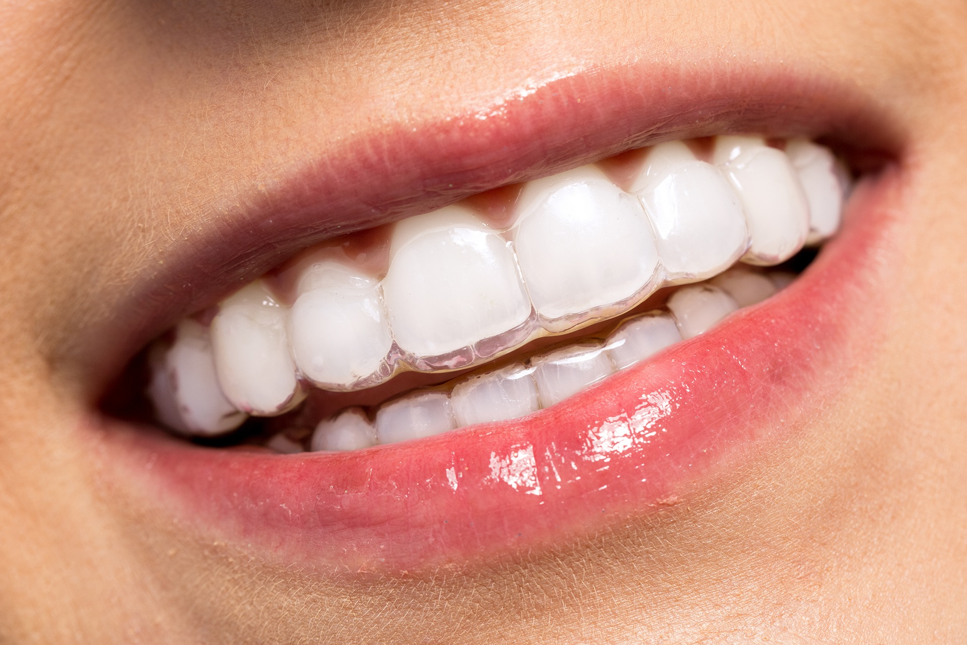 Are Clear Braces a Popular Option for Teeth Straightening? - Palm Beach  Dentistry Delray Beach Florida